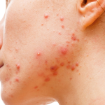 Acné - Acne