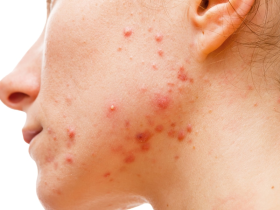 Acné - Acne
