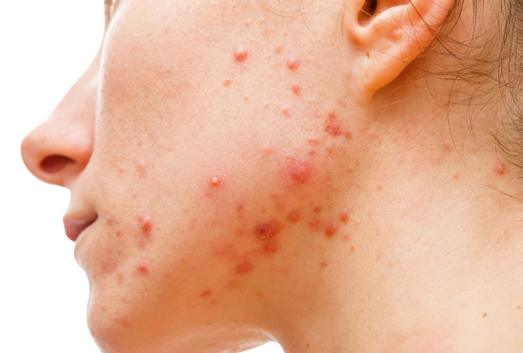 Acné - Acne