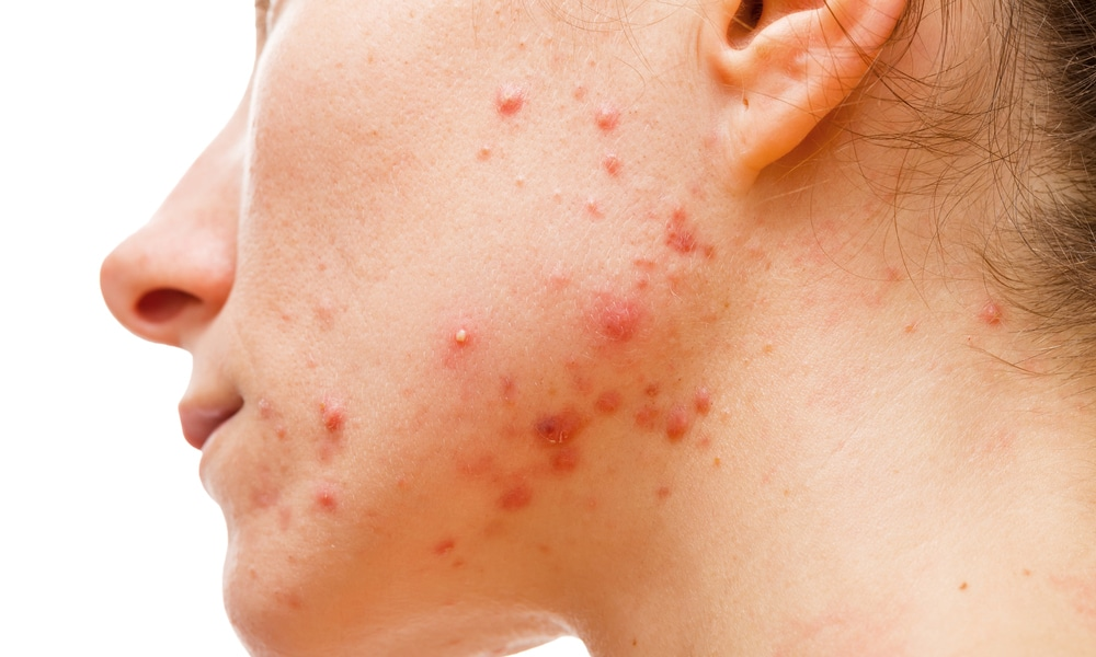 Acné - Acne