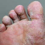 Mycose des pieds (pied d&rsquo;athlète) - Mycose des pieds