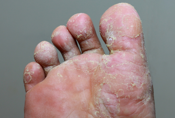 Mycose des pieds (pied d&rsquo;athlète) - Mycose des pieds