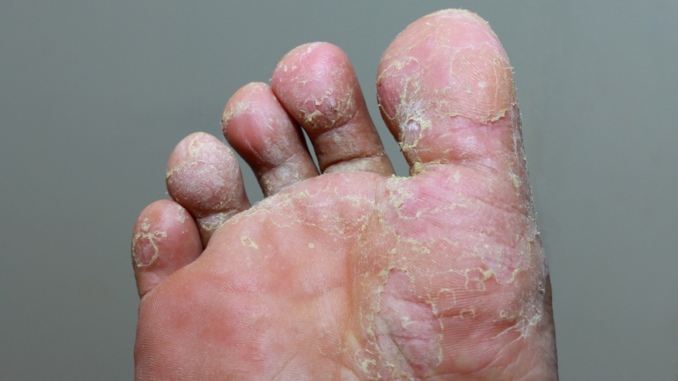 Mycose des pieds (pied d’athlète) - Mycose des pieds