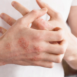 Psoriasis - Psoriasis