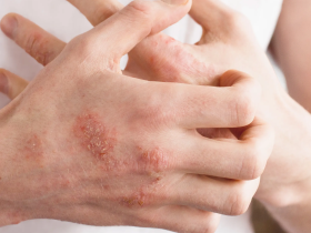 Psoriasis - Psoriasis