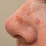 Carcinome basocellulaire - Application Senskin - capture écran