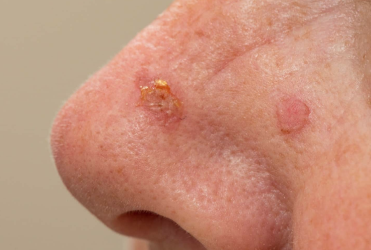 Carcinome basocellulaire - Application Senskin - capture écran