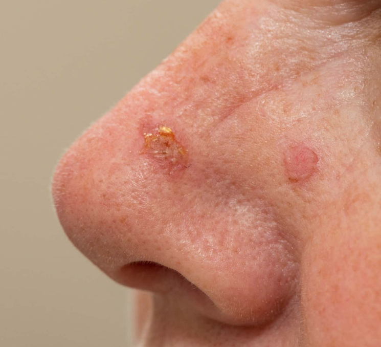 Carcinome basocellulaire - Application Senskin - capture écran