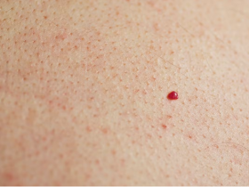 Angiome cerise - Application Senskin - capture écran