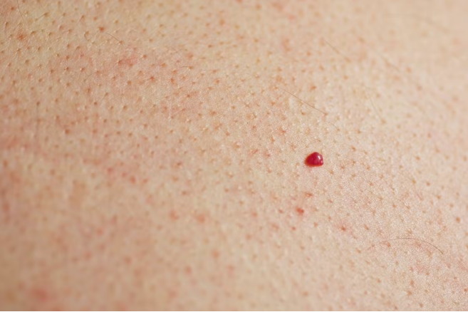 Angiome cerise - Application Senskin - capture écran