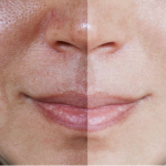 Hyperpigmentation - Application Senskin - capture écran