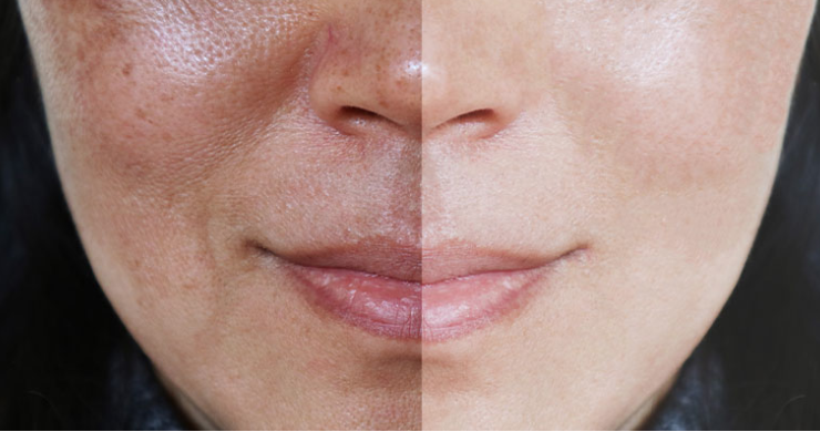 Hyperpigmentation - Application Senskin - capture écran