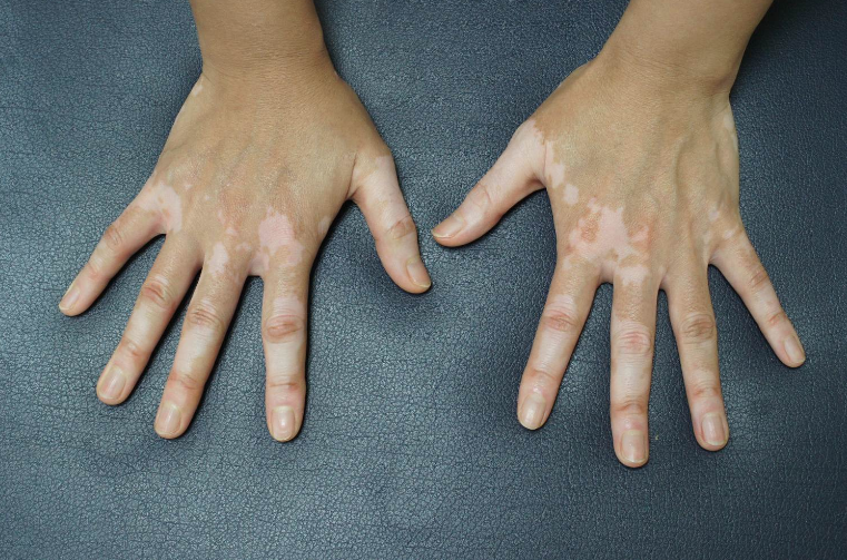 Hyppoimentationg - Application Senskin - capture écran