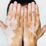 Vitiligo - Vitiligo