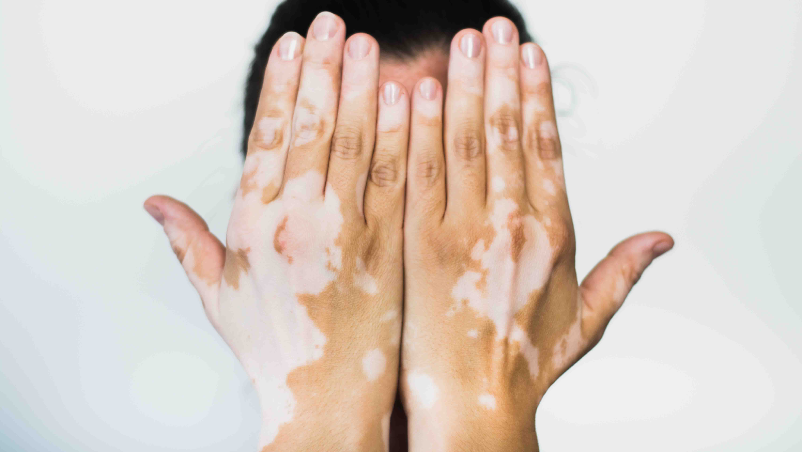 Vitiligo - Vitiligo