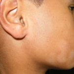 Thumbnail large blog pityriasis alba nih 1 tcm88 2627703