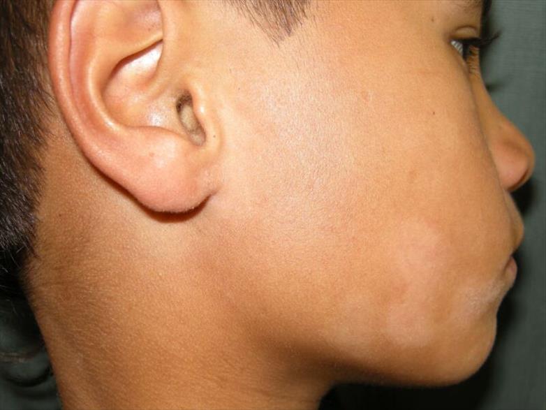 Thumbnail large blog pityriasis alba nih 1 tcm88 2627703